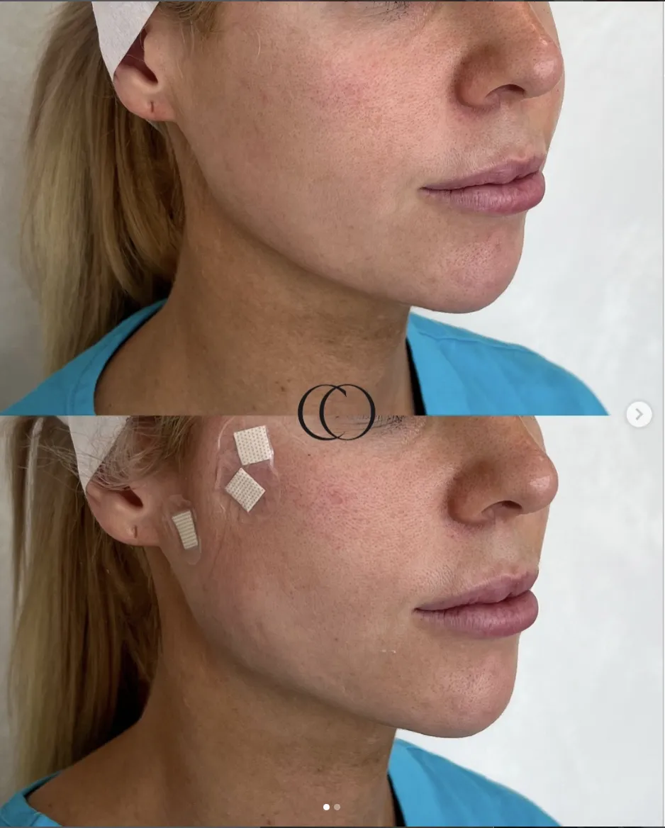 Thread lift before and after, patient 3