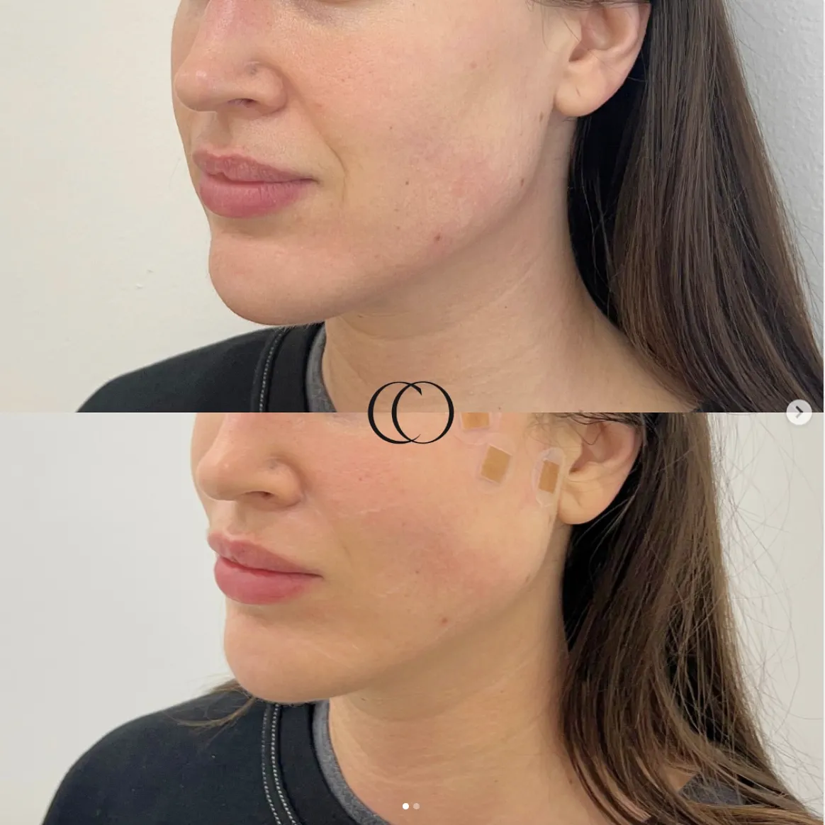 Thread lift before and after, patient 1