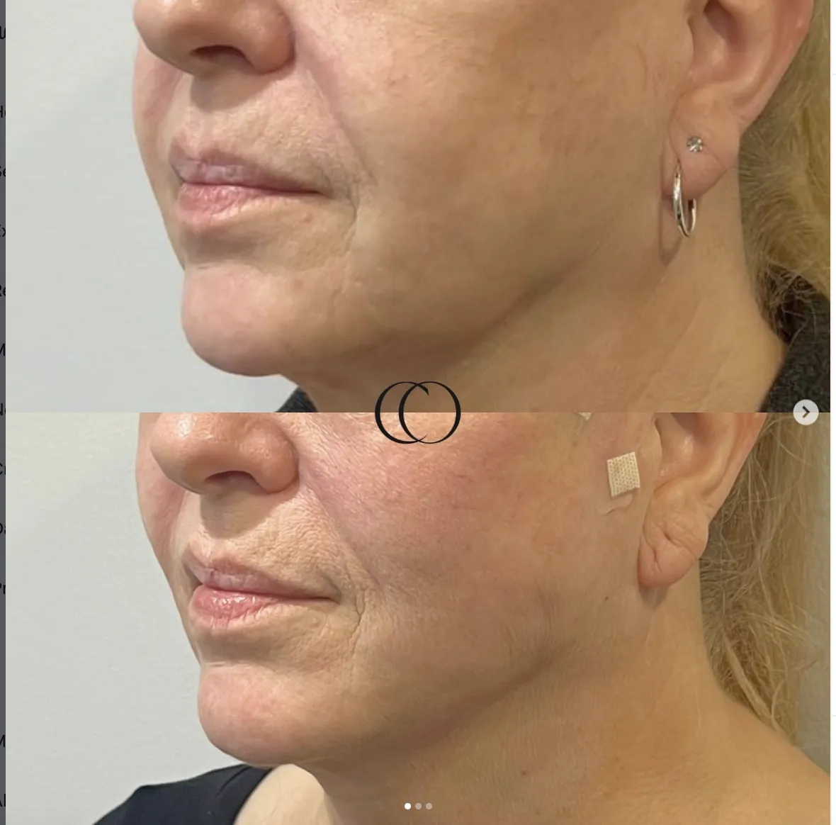 Thread lift before and after, patient 4