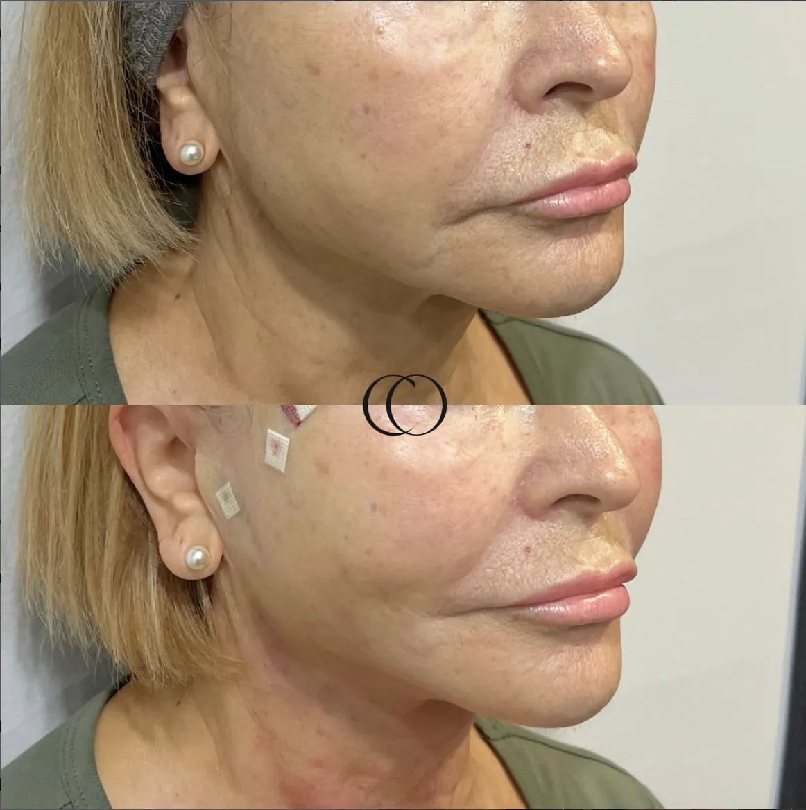 Thread lift before and after, patient 2