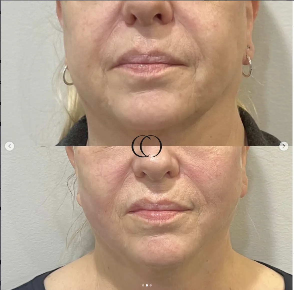 Thread lift before and after, patient 5