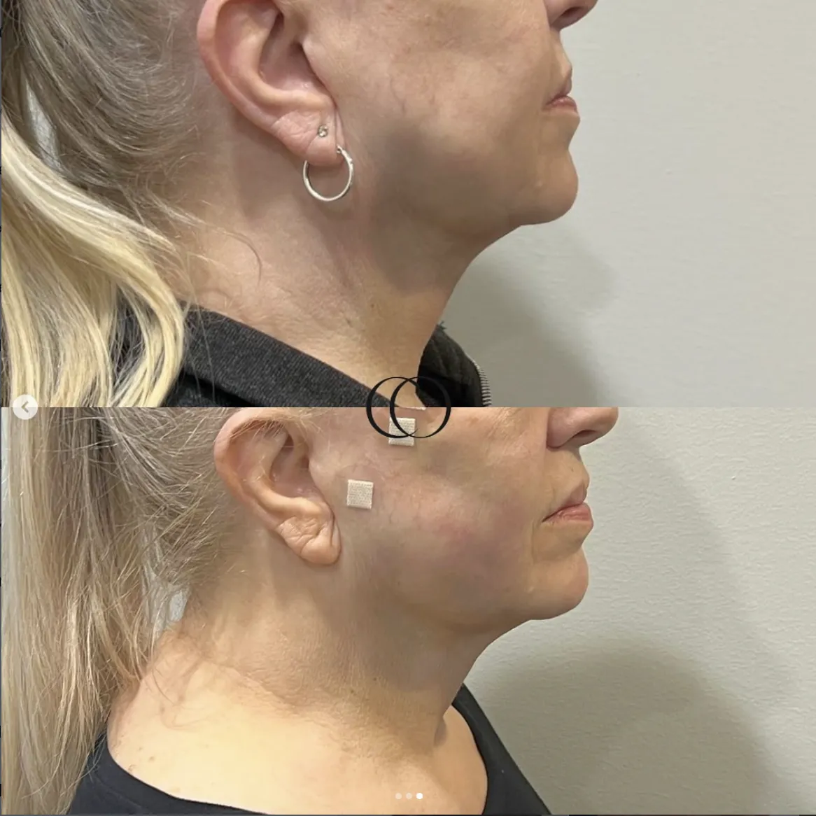Thread lift before and after, patient 6